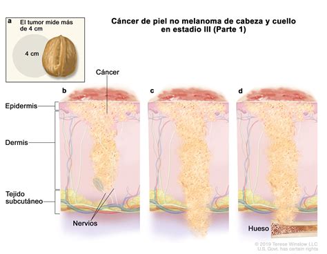 Tratamiento del cáncer de piel - NCI