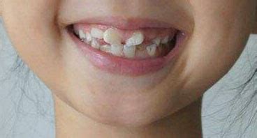 牙齿矫正的年龄 - 牙博士口腔国际连锁机构