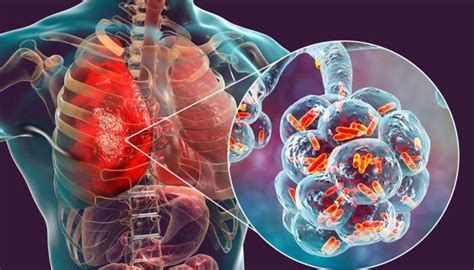 Signs and Symptoms of Post-Covid Lung Damage | Zee News Kannada