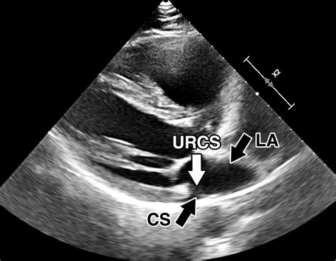 Frontiers | Case report: Robotic repair of unroofed coronary sinus