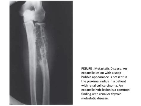 Lytic lesions of bone | PPTX