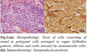 An Uncommon Case of Filum Terminale Paraganglioma