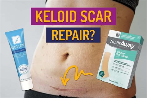 What Causes Keloids After A C-Section (And How To Prevent Them) – Fairy ...
