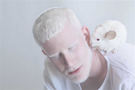 Caucasian Albino People
