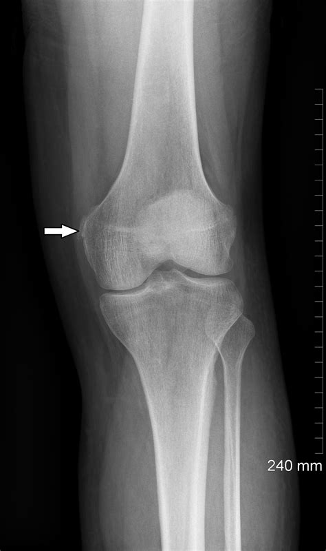 Radiopaedia case Pellegrini-Stieda lesion id: 54424 study: 60717 - NC ...