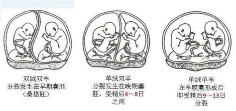 怀上MCDA（单绒双羊）双胞胎，需要准备什么？ - 知乎