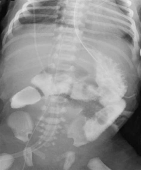 Ligament Of Treitz X Ray