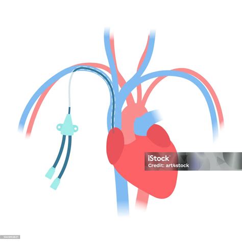 Tunneled Central Venous Catheter