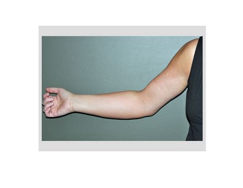 arm-swelling-lymphedema-after-armlift-dr-barry-eppley-indianapolis - Explore Plastic Surgery