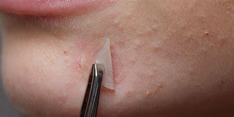 Scientists Just Discovered a Pimple Patch That May Work Better Than Most Acne Creams