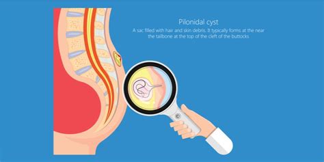 Pilonidal Cyst Disease - Pilonidal Cyst: Causes, Symptoms, Treatments ...