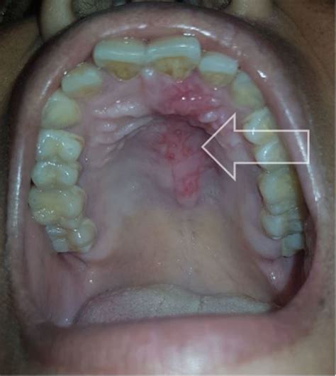 Swollen Mouth Palate