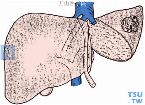 【图】肝左外叶切除术 - 外科手术学 - 天山医学院