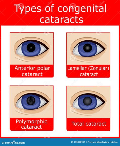 Types Of Congenital Cataracts Cartoon Vector | CartoonDealer.com #105048911