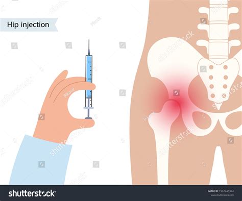 Cortisone Shot In Hip