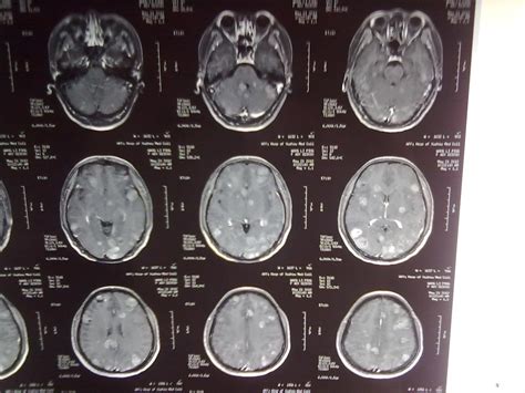 头颅检查，CT、核磁共振哪个好？贵的会更准吗？