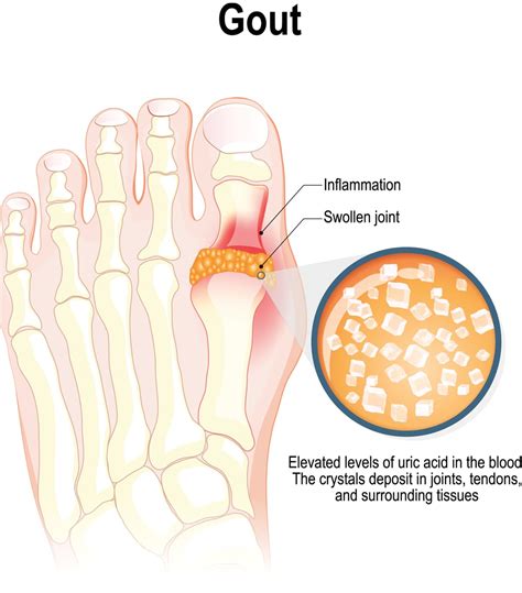 Gout. What is it and does an injection help? - Ultrasound Guided Injections