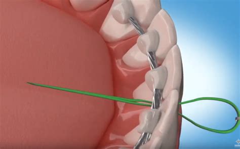 Image result for Using a Floss Threader
