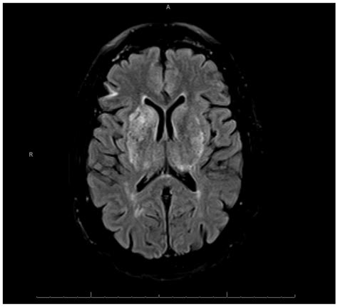 Cocaine-Induced Limbic Encephalopathy Manifesting as Acute Amnesia: A ...