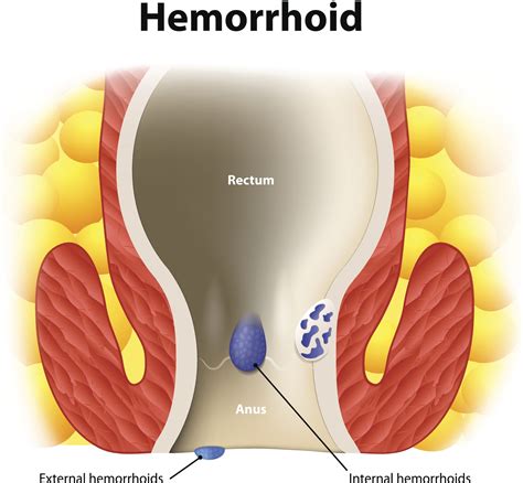 Rectal Internal Hemorrhoids