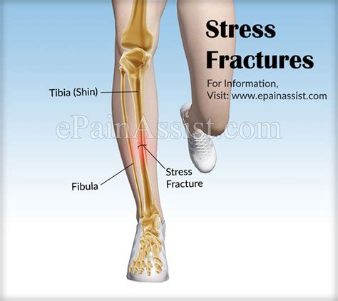 Stress Fractures|Causes|Symptoms|Treatment|Recovery|Complications