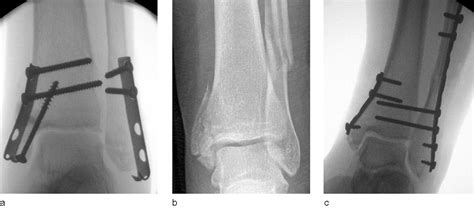 Figure 11 from Current concepts review: ankle fractures. - Semantic Scholar