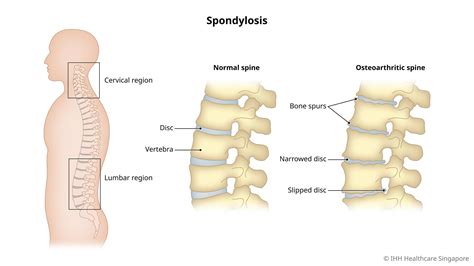 Spinal Spondylosis (Cervical & Lumbar) - Causes, Symptoms & Signs ...