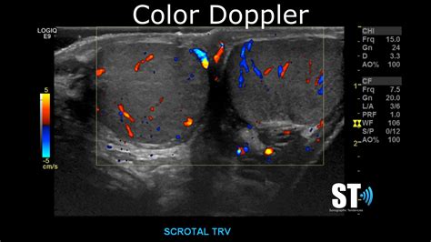 Normal Testicular Ultrasound