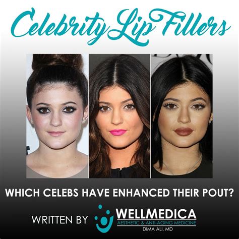 Bildergebnis für famous+lip+fillers
