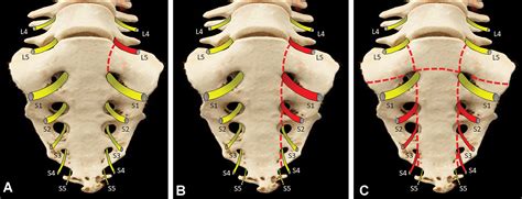 CT of Sacral Fractures: Classification Systems and Management | RadioGraphics
