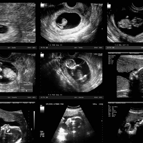 9 Weeks Pregnant Ultrasound 2022