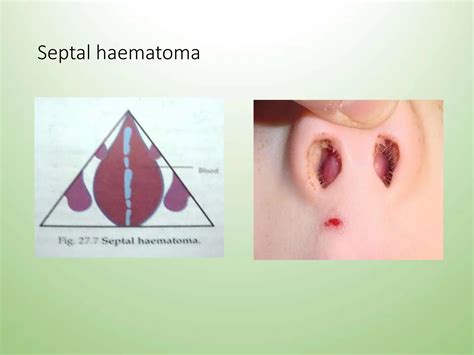nasalseptumanditsdiseases................ | PPT