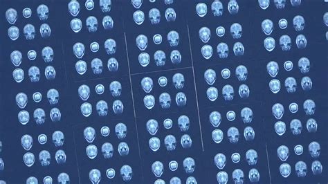 AIR™ Recon DL testimonials and white papers | GE HealthCare (India)