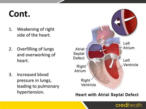 PPT - Atrial Septal Defect / Hole in Heart – Things You Should Know ...