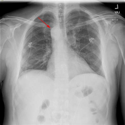 Right Aortic Arch - X Rays Radiology Case Studies - CTisus CT Scanning