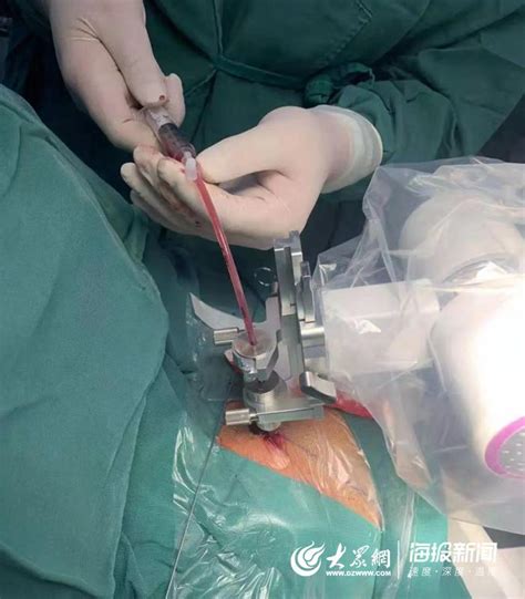 菏泽市立医院为30岁患者行脑干出血精准穿刺引流手术_菏泽新闻_大众网菏泽