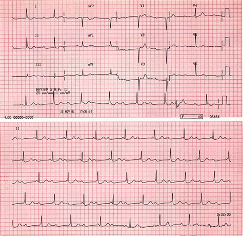 Third Degree Atrioventricular Av Block The Atrial And - vrogue.co