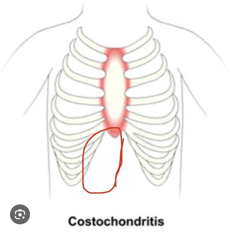 Twitch, spasms, heart issue?! : r/costochondritis