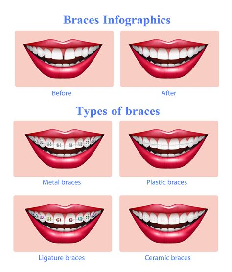 What Are The 10 Different Types Of Braces at Caleb Brownbill blog