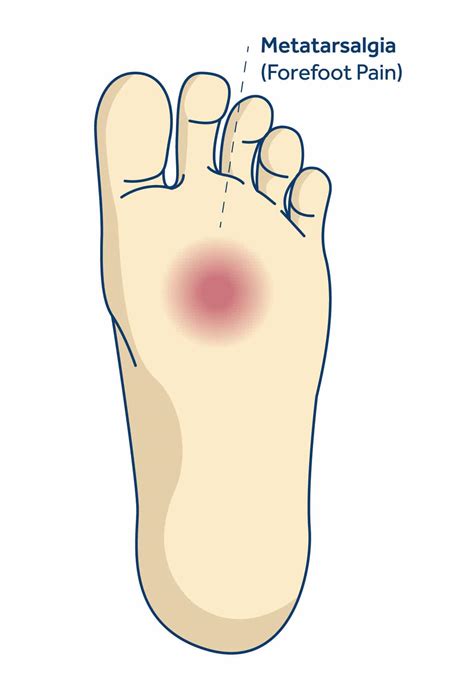 Pain Under Toes On Sole Of Foot Store | emergencydentistry.com