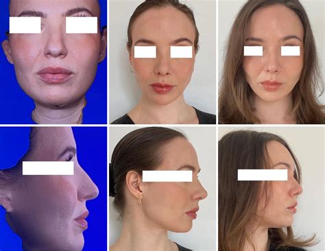 Post Surgery Swelling Face