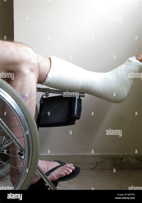 Curing Plaster Cast 的图像结果