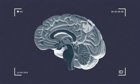 Sanofi to enhance neurology pipeline with new acquisition