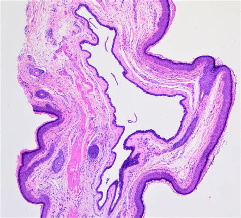 Eyelid Cyst Histology Pathology Of The Eyelids | SpringerLink