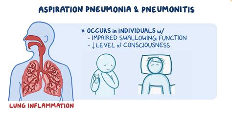 Aspiration pneumonia and pneumonitis: Clinical sciences - Osmosis Video Library