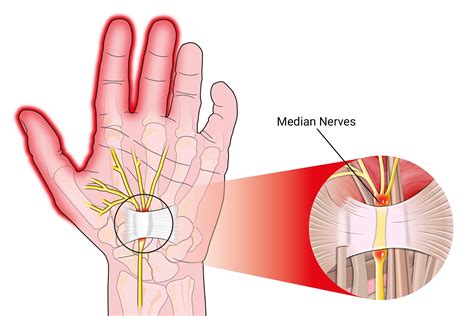 Reduce Pain In Carpal Tunnel Syndrome at Harold Case blog