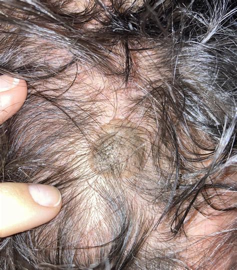 Lump on scalp, should we be concerned? : r/DermatologyQuestions