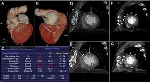 Study supports CT coronary angiography before invasive coronary ...