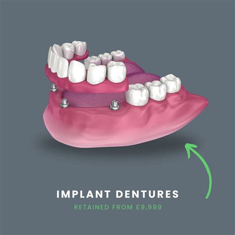 Cost of Dentures - What You Can Realistically Expect To Pay