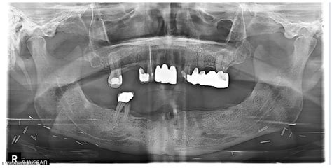 Prophylactic Use of Pentoxifylline and Tocopherol for Prevention of Osteoradionecrosis of the ...
